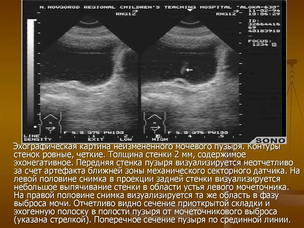 УЗИ нормального мочевого пузыря. Толщина стенки мочевого пузыря УЗИ. Измерение объема мочевого пузыря на УЗИ. Ультразвуковое исследование мочевого пузыря у женщин.