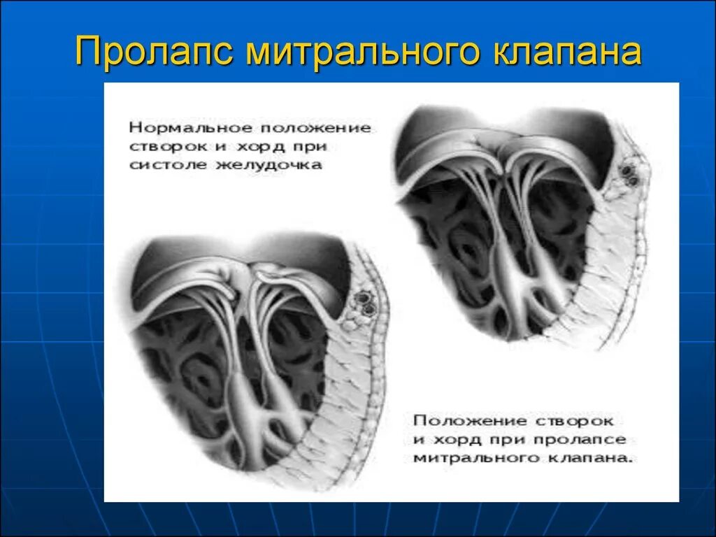 Что такое пролапс митрального клапана. Пролапс митрального клапана. Пролабирование митрального клапана. Пролабирование створок митрального клапана. Провисание створок митрального клапана.