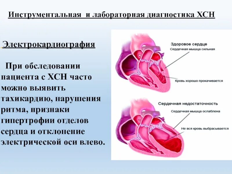 Сердечная недостаточность презентация. Недостаточность левых отделов сердца. Сердце гипертрофия сердечная недостаточность. Сердечная недостаточность обследование пациента. Сердечная недостаточность обследование