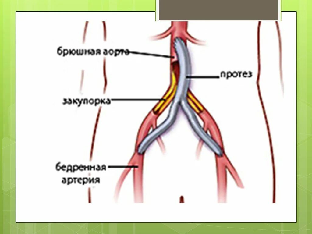 Бифуркационное аорто-бедренное шунтирование. Аорто бедренная и подколенная шунтирование. Бифуркационное аорто-бедренное шунтирование ход операции. Аорто брюшное шунтирование.