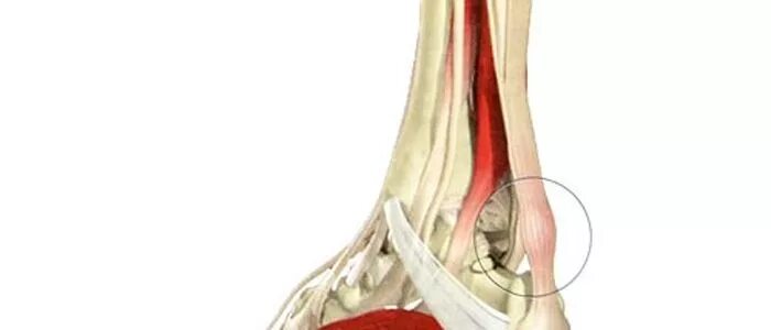 Тендиноз ахиллесова сухожилия. Тендинит ахиллова сухожилия. Тендиниты ахиллова сухожилия. Тендинопатия ахиллова сухожилия.