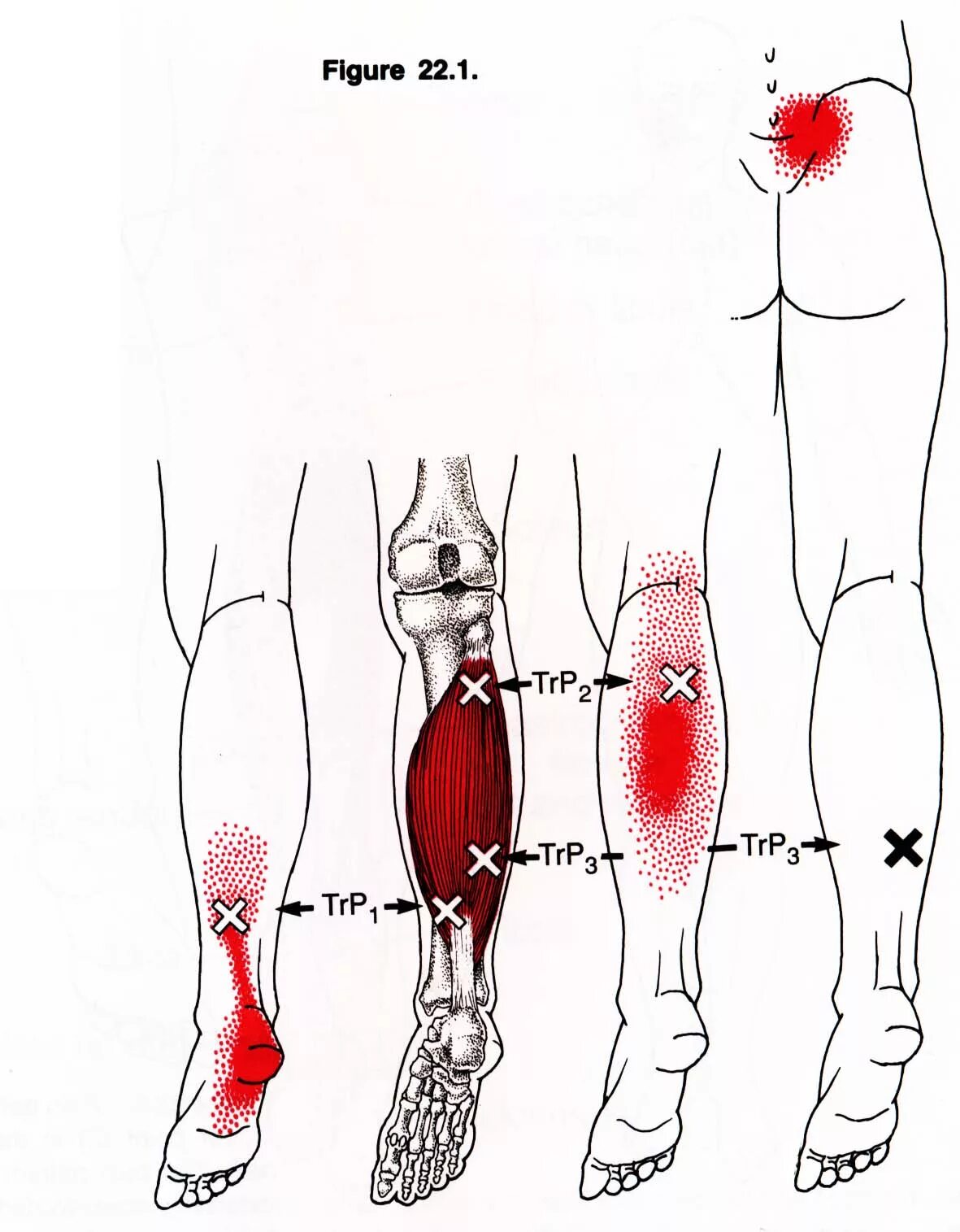 Триггерные точки икроножной мышцы. Триггерные точки мышц голени. Триггерные точки камбаловидной мышцы. Триггерные точки большеберцовой мышцы. Сильно болит бедро ноги