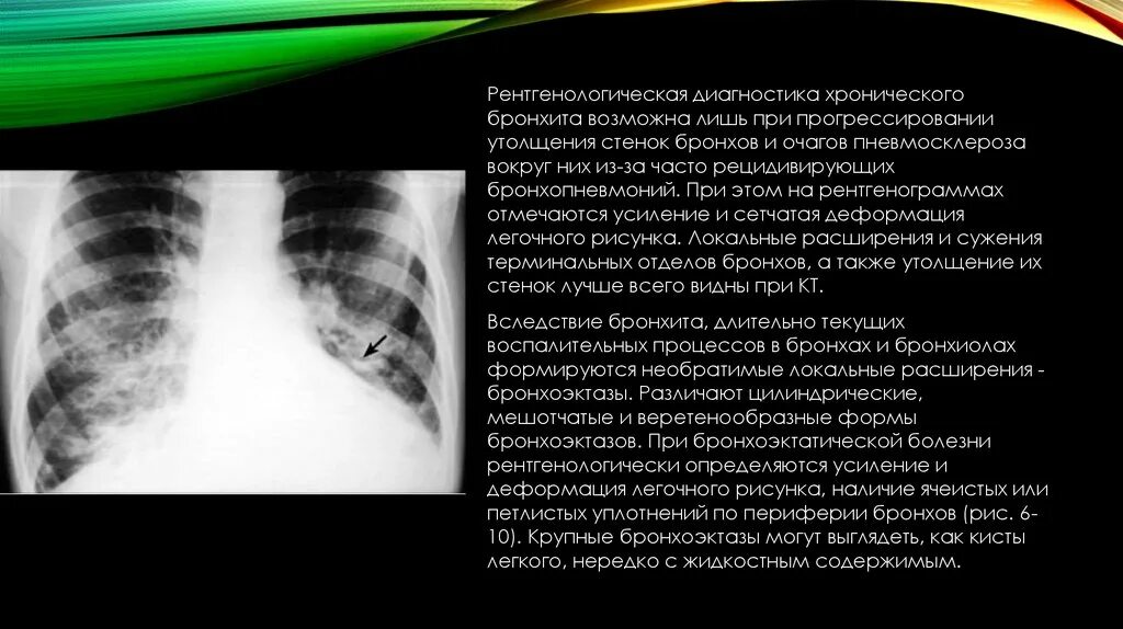 Хронический обструктивный бронхит рентген. Ячеистая деформация легочного рисунка. Легочный рисунок деформирован. Легочный рисунок усилен деформирован.