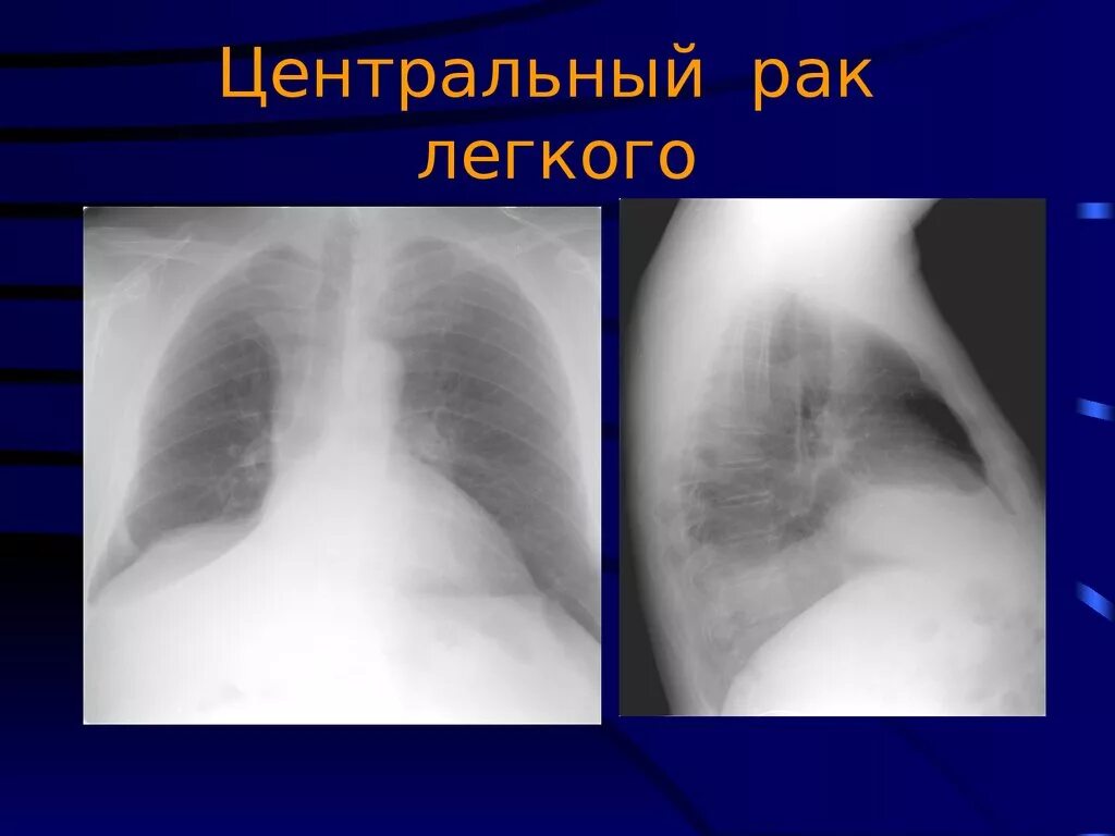 Стадии рака бронха. Центральная опухоль легкого. Рентгенологическая картина центрального рака.. Центральная опухоль правого легкого. Доброкачественная опухоль легкого.