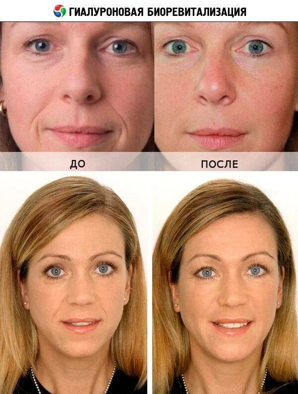 Биоревитализация лица на какой день виден результат. Уколы гиалуроновой кислоты в лицо. Гиалуронка инъекции для лица. Инъекции гиалуроновой кислоты до и после. Лицо до и после гиалуроновой кислоты.