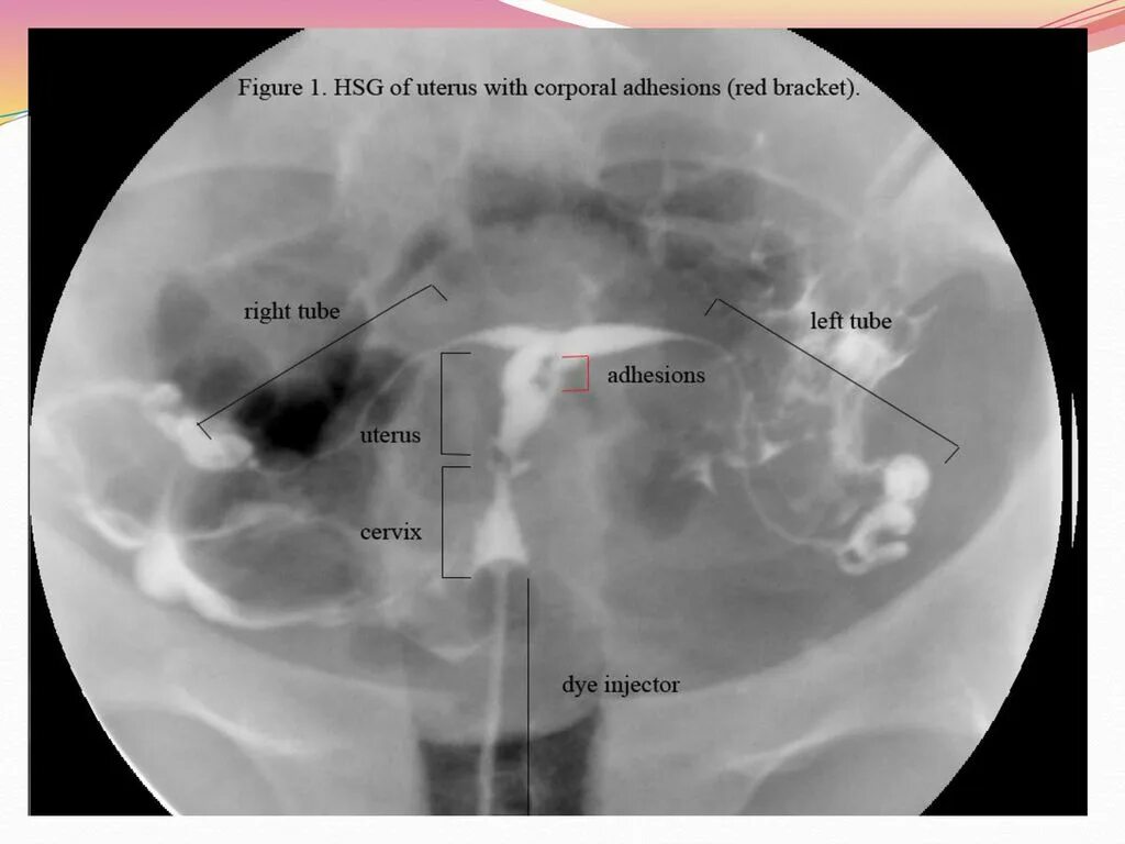 Жжение в уретре после. Синдром Ашермана мкб 10. Синдром Ашермана гистеросальпингография. Снимок труб на проходимость.