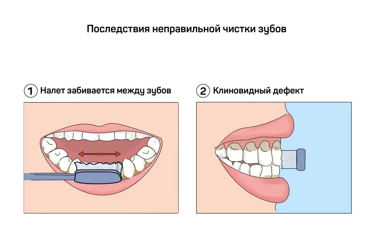 Схема чистки зубов. Контролируемой чистки зубов.