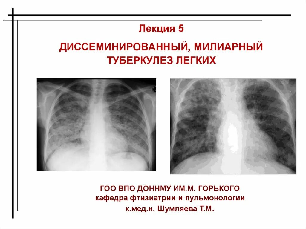 Диссеминированный туберкулез фаза инфильтрации