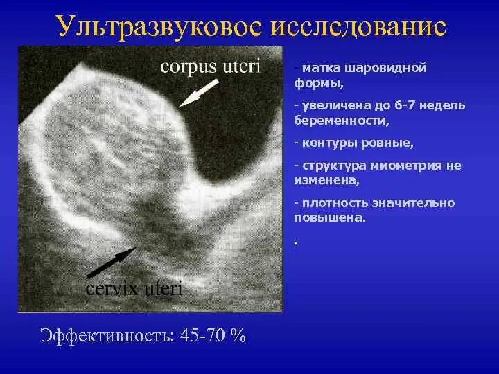 Ретроцервикальный эндометриоз по УЗИ. Матка шарообразной формы. Форма матки шаровидная на УЗИ. Матка увеличена до 6 недель