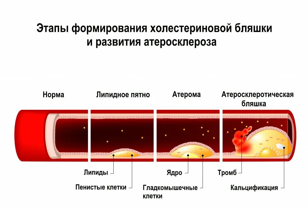 Очистка сосудов от бляшек. Холестериновые бляшки в сосудах. Атеросклеротическая бляшка. Атеросклеротические бляшки в сосудах.