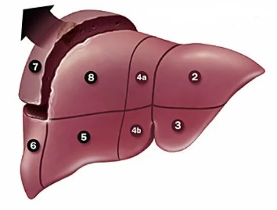 Печень 9 8 7. Лобэктомия – резекция доли печени;. Атипическая гемангиома печени. Резекция 6, 7 сегментов печени. Гемангиома печени 1 сегмент.