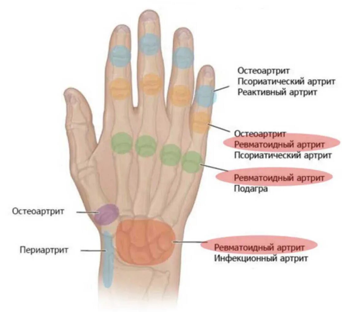Боль в суставах при ревматоидном артрите. Псориатический артрит симптомы. Ревматоидный псориатический артрит. Определяющие симптомы ревматоидного артрита. Псориатический артрит схема.
