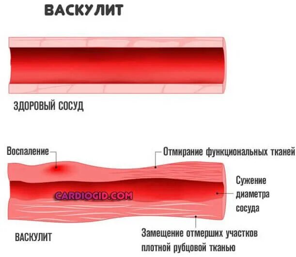 Воспаление ткани латынь. Васкулит с поражением сосудов крупного калибра. Геморрагический васкулит кожный. Васкулит мелких сосудов. Лейкоцитокластический васкулит.