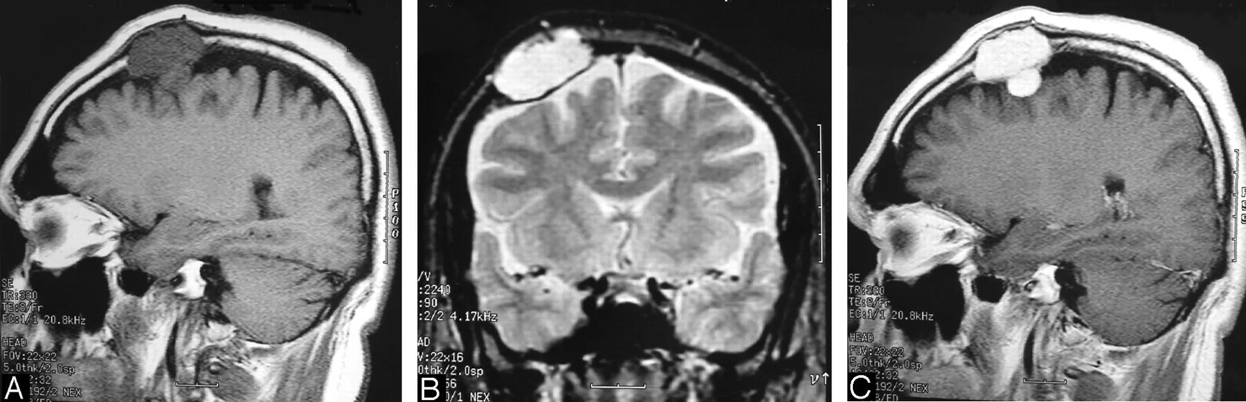 Опухоли теменной. Менингиома головного мозга мрт. Пахионовы грануляции на кт лобной кости. Менингиома верхнего сагиттального синуса.