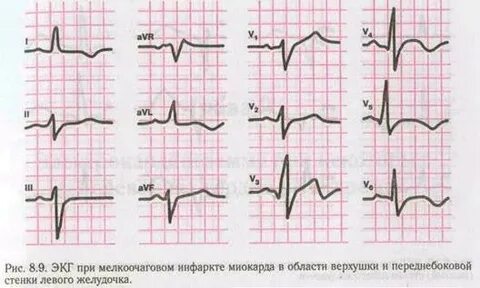 Нарушения в миокарде нижне боковой стенки