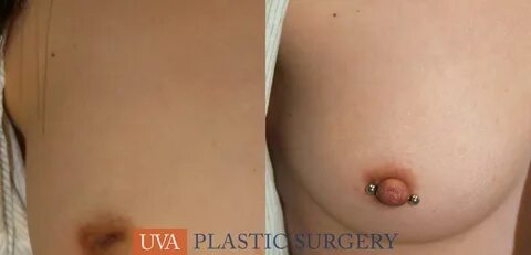 Inverted Nipple Correction Case 7 Before & After View #1 Charlottesvill...