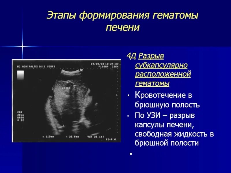 Этапы формирования гематомы печени. Свободная жидкость в брюшной полости на УЗИ. Гематома брюшной полости на УЗИ. Гематома в стадии организации