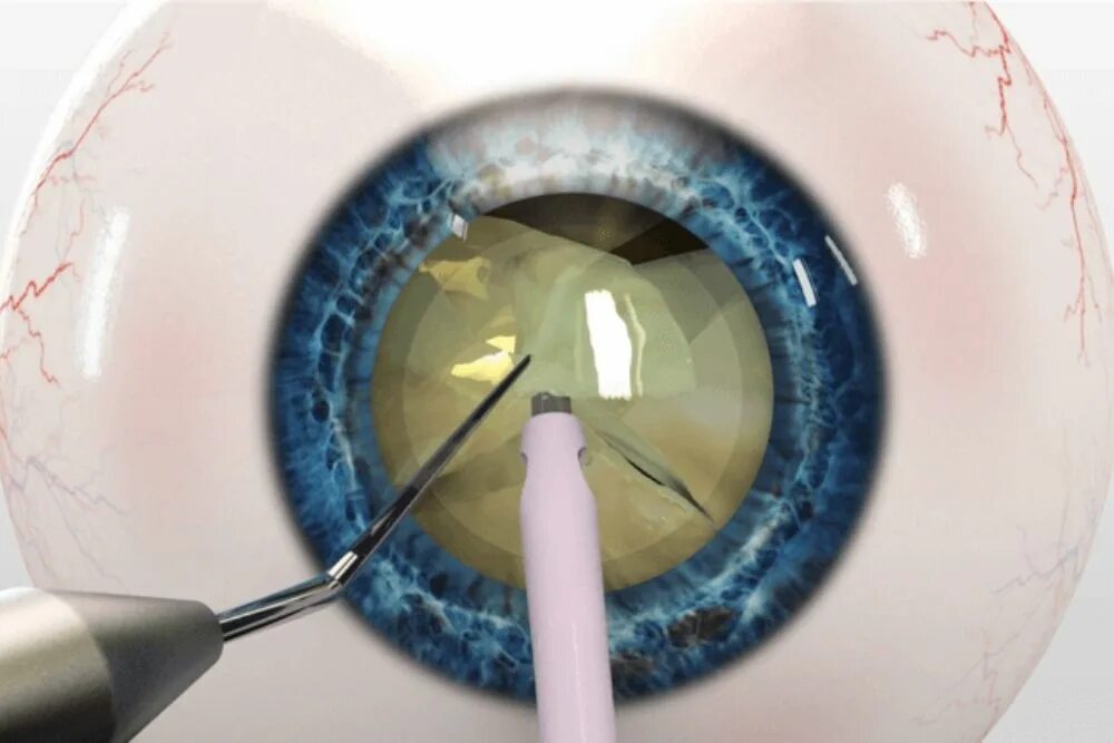 Ультразвуковая факоэмульсификация с имплантацией ИОЛ. Факоэмульсификация катаракты. Операция ультразвуковая факоэмульсификация катаракты. Факоэмульсификация катаракты с имплантацией ИОЛ.