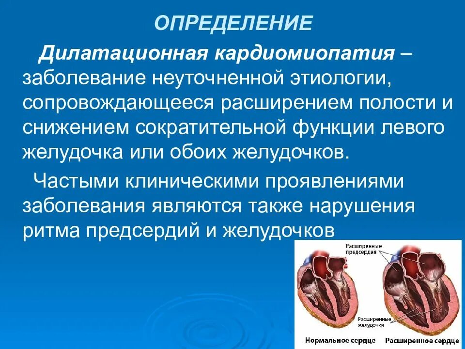 Заболевания левого желудочка. Дилатационная кардиомиопатия. Кардиомиопатии дилатационная. Клинические проявления дилатационной кардиомиопатии. Причины дилатационной кардиомиопатии.