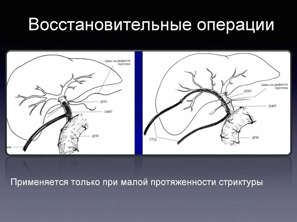 Уплотнение желчного протока