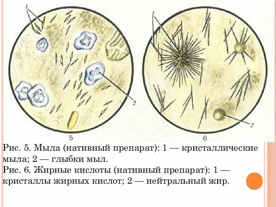 Микроскопия нативного препарата. Кристаллы жирных кислот микроскопия кала. микроскопия кала нативный препарат. копрология кала микроскопия. соли жирных кислот в кале микроскопия.