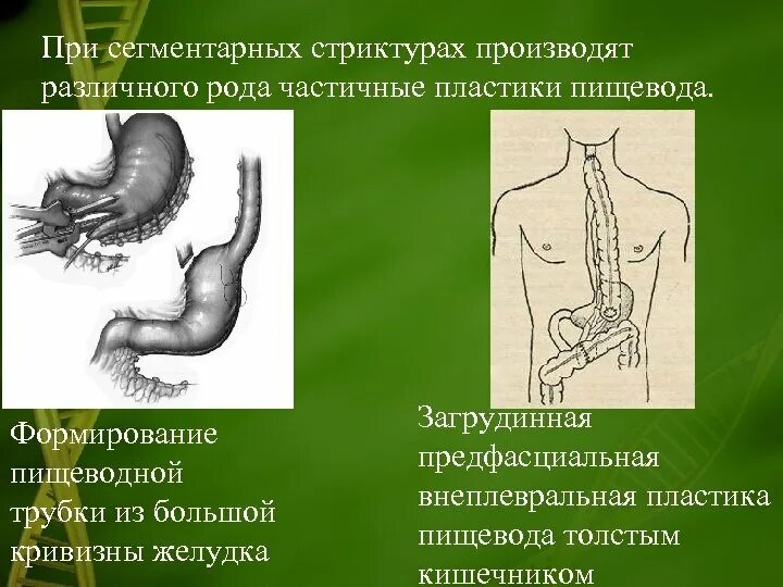 Искусственный пищевод. Пластика пищевода желудком. Частичная пластика пищевода. Пластика пищевода желудочной трубкой.