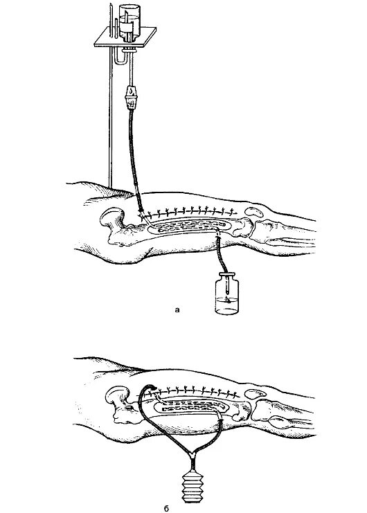 гнойное дренирование