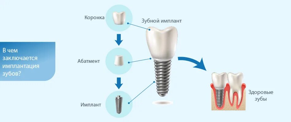 Зубной имплант Штрауман. Схема имплант абатмент коронка. Схема установки стоматологических имплантов.