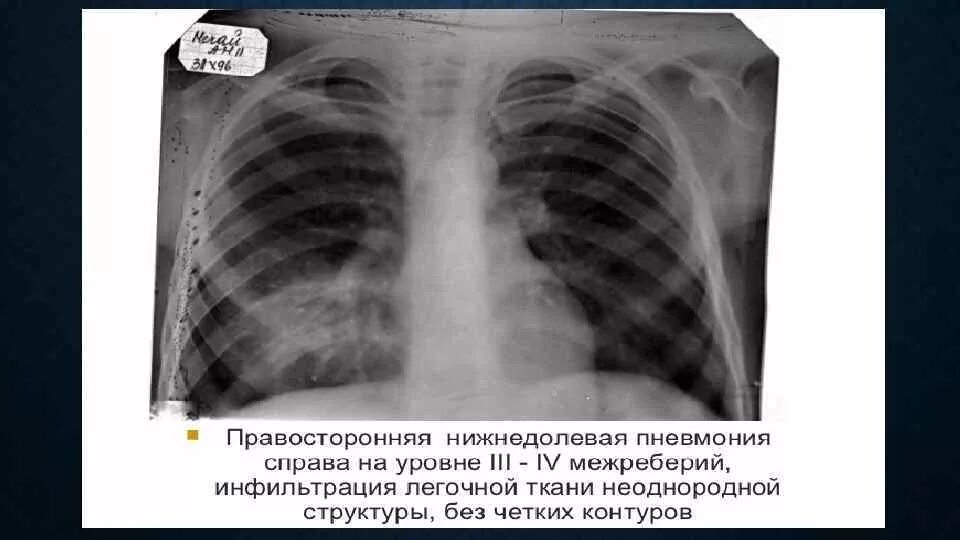 Пневмония в правой нижней доле. Правосторонняя нижнедолевая очаговая пневмония рентген. Правосторонняя нижнедолевая пневмония рентген. Рентгенография грудной клетки пневмония нижнедолевая. Двухсторонняя нижнедолевая пневмония рентген.