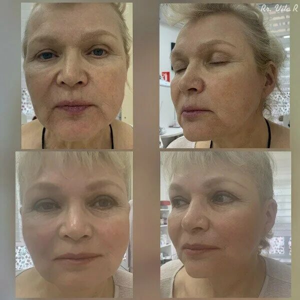 фотодинамическая косметология отзывы