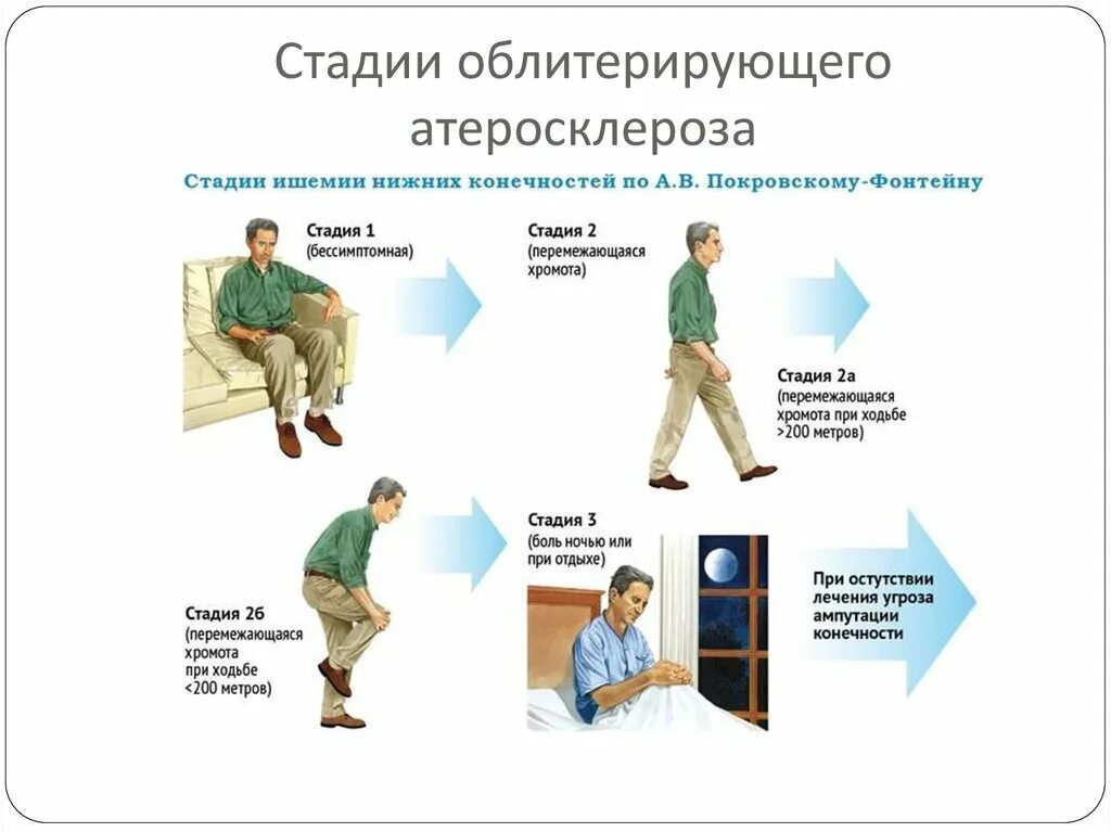 Классификация ишемии конечностей. Облитерирующий атеросклероз стадии. Степени облитерирующего атеросклероза нижних конечностей. Перемежающая хромота основной признак заболевания. Стадии перемежающейся хромоты.