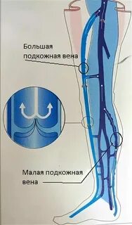 Клапан бпв голени
