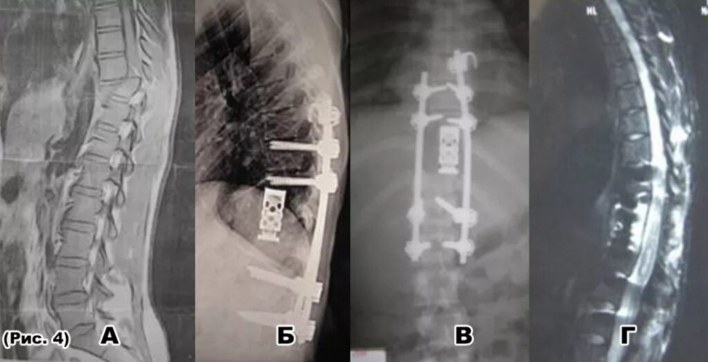 Туберкулезный спондилит рентген. Туберкулез позвонков мрт. Спондилит поясничного отдела позвоночника рентген. Спондилит th8 th9. Операция на позвоночник с металлоконструкцией инвалидность