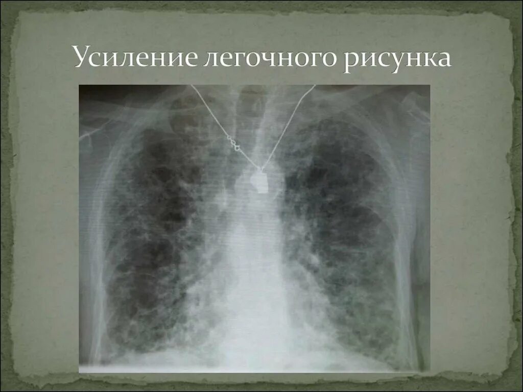 Усиление бронхиального рисунка рентген. Усиление легочного рисунка. Умтление легосного рисунка. Усил ение логочного рисунка.