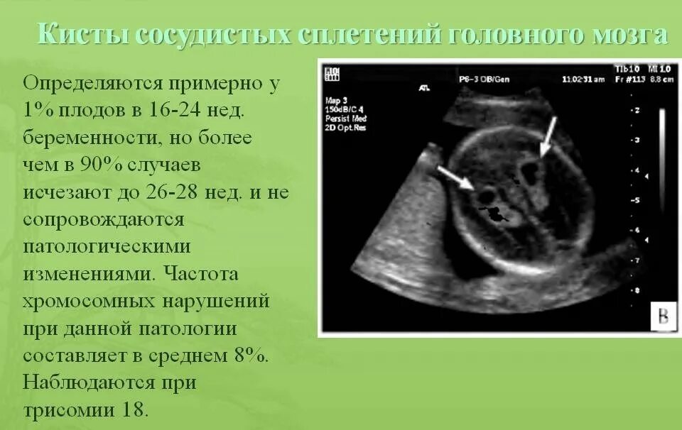 Киста сосудистого сплетения УЗИ. Анатомия мозга плода на УЗИ. Киста сосудистого сплетения у плода. Киста сосудистого сплетения эмбриона. Сосудистая киста головного мозга у плода