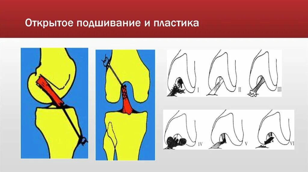 Растяжение капсульно-связочного аппарата. Пластика связочного аппарата по Борскому.