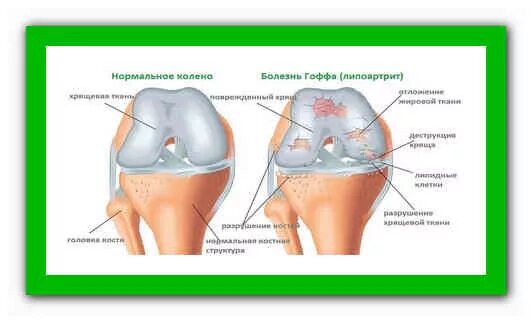 Отек гоффа коленного сустава. Клетчатка жирового тела Гоффа. Тело Гоффа коленного сустава. Жировые тела коленного сустава. Синдром жирового тела Гоффа.