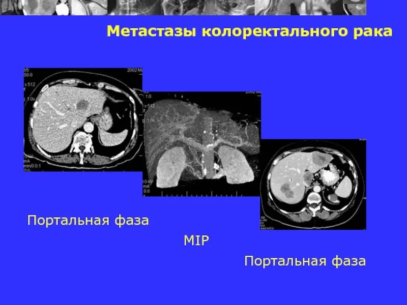 Вероятность метастаз. Метастазы колоректального. портальная фаза сканирования кт.