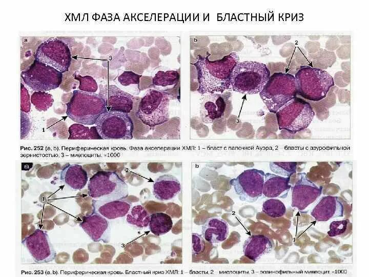 Фазы миелолейкоза