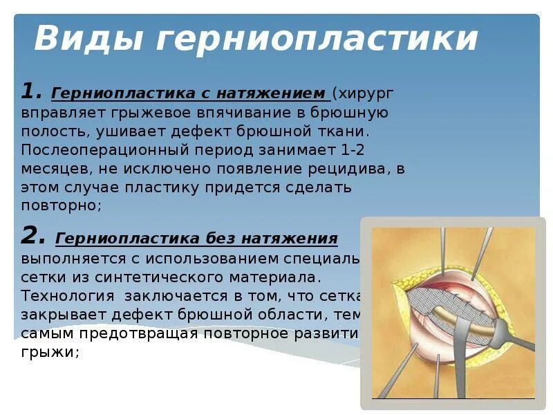 Пупочная грыжа у взрослых код по мкб. Натяжная герниопластика. Современные методы герниопластики. Герниопластика методы.