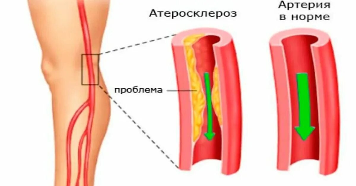 Лечим атеросклероз сосудов ног. Облитерирующий атеросклероз артерий нижних конечностей. облитерирующий атеросклероз сосудов конечностей. облитерация сосудов нижних конечностей. облитерирующий атеросклероз артерий нижних конечностей симптомы.