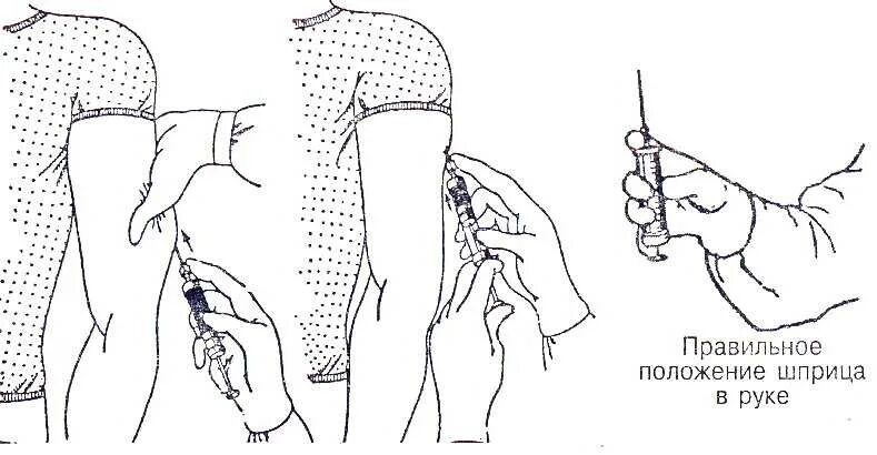 Подкожно инъекция алгоритм. Подкожная инъекция в плечо техника. Схема подкожного введения уколов. Техника постановки подкожной инъекции в плечо.