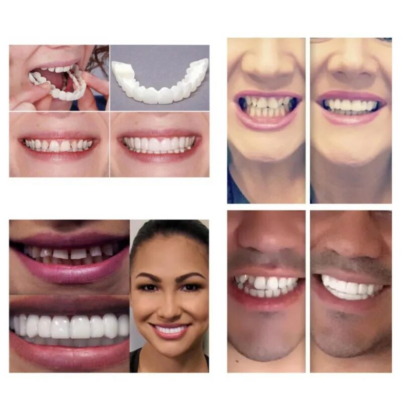 Сменные зубы. Виниры для зубов snapon smile. cъемные виниры perfect smile veneer (snap on smile). зубные виниры комплект temporary tooth smile. накладные зубы snap on smile.