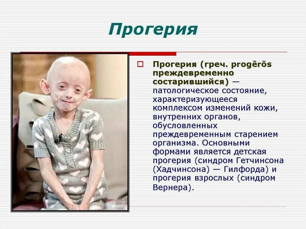 Какие заболевания похожи. Наследственные заболевания прогерия. детская прогерия синдром гетчинсона. прогерия гетчинсона гилфорда. прогерия тип наследования.