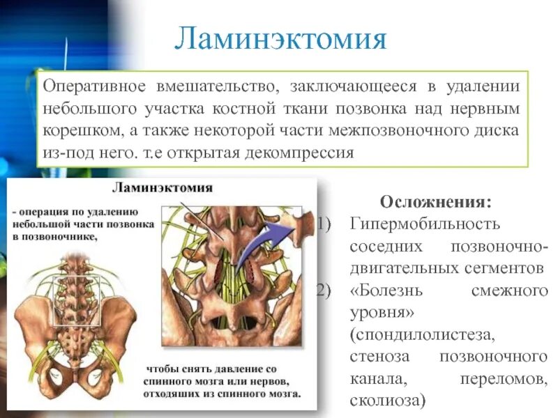 Заключающаяся в удалении