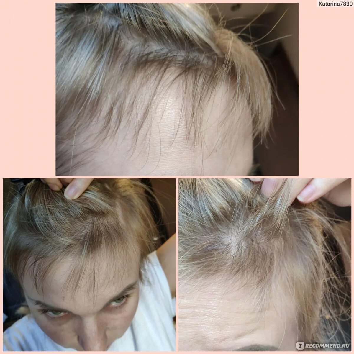Никотиновая кислота для волос волосы до и после. Никотинка для волос до и после. Никотиновая кислота для волос до и после. Волосы после никотиновой кислоты. Волосы после коронавируса