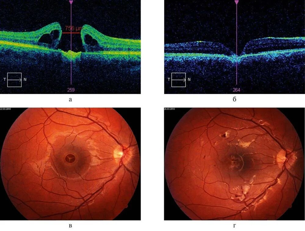 Макулярный отек лечение. Сквозной макулярный разрыв сетчатки. Макулярный разрыв отслойка сетчатки. Периметрия отслойка сетчатки. Ламеллярный макулярный разрыв сетчатки.