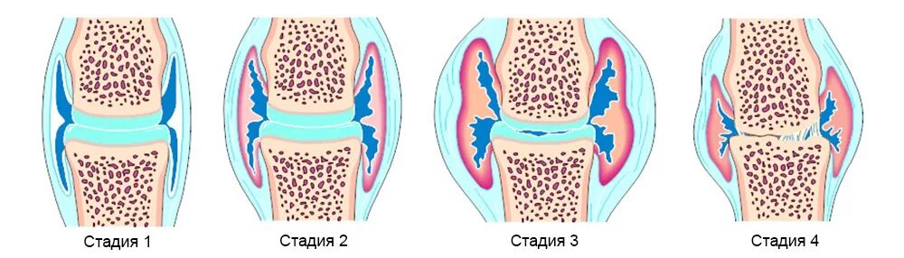 Артрит суставов стадии. Ревматоидный артрит 4 стадия. ревматоидный артрит гнойный. артрит 4 стадии коленного сустава. ревматоидный артрит коленного сустава.
