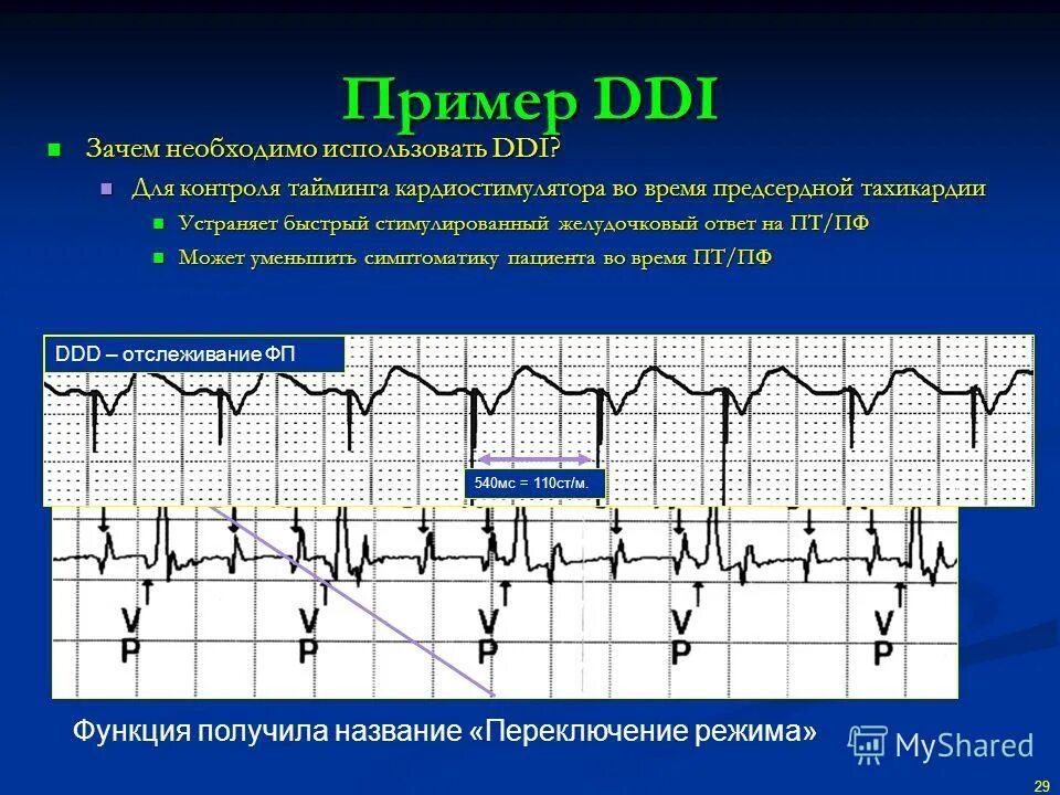 Режимы работы кардиостимулятора. Двухкамерный кардиостимулятор на ЭКГ. Режим DDI кардиостимулятора. Экс в режиме DDD на ЭКГ.