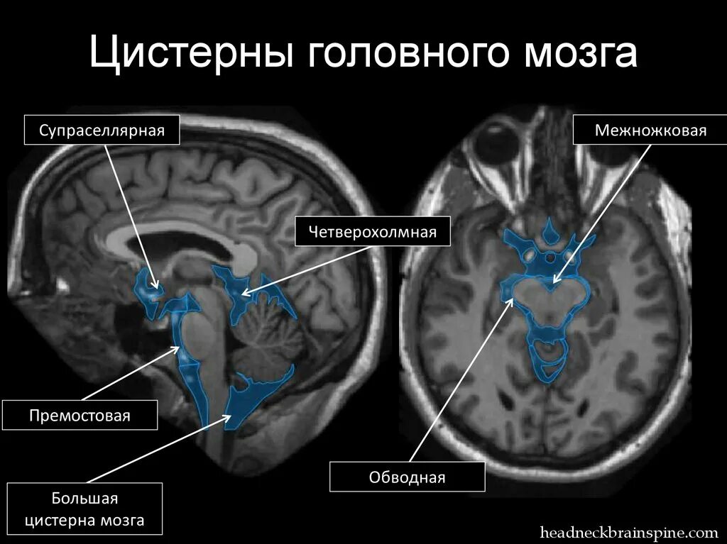 Цистерны головного мозга на мрт. Цистерна Меккеля головной мозг. Цистерны основания головного мозга анатомия. Цистерны основания головного мозга на кт.